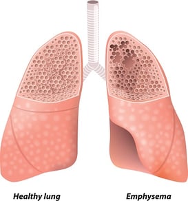 illustration of lung with emphysema